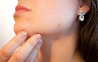 Drinking Water to Clear Up Acne